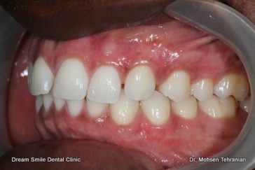 After Dark Gum Pigmentation