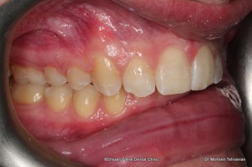 After Six Month Smiles Case 02