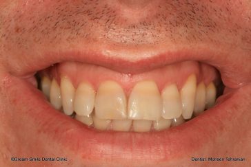 Before E-max minimal preperation Veneers