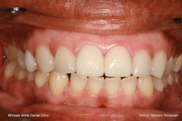 After E-max veneers and Crowns