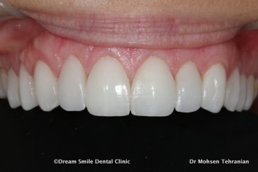 After Emax Veneers no preperation.