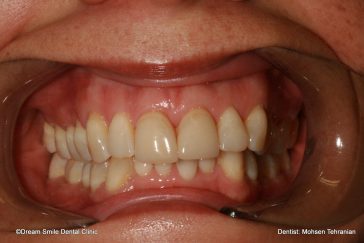 Before Combination of whiteing and 2 e-max veneers