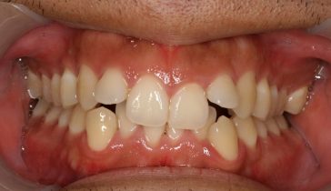 Before Invisalign Full Complex