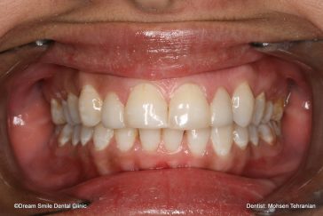 After Combination of Invisalign and 2 E-max veneers