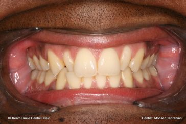 Before Combination of Invisalign and 2 composite veneers