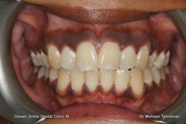 Before Gum Whitening