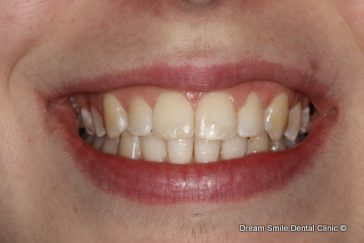 After Invisalign Cross-bite