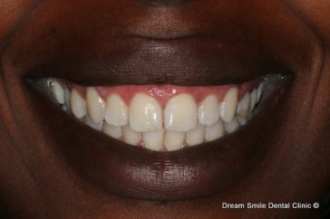 After Gum Whitening