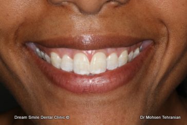 After Gum Whitening