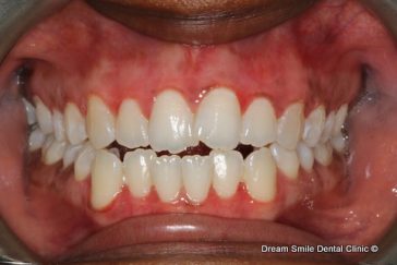 After Laser Gum Bleaching