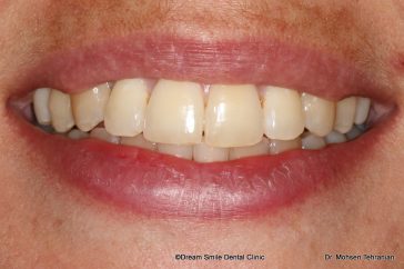 After Invisalign Full with Dream Smile
