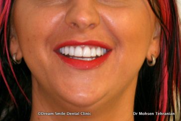 After Emax Veneers no preperation.