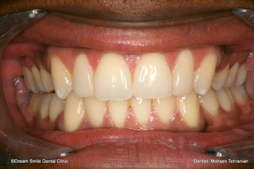 After Combination of Invisalign and 2 composite veneers