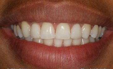 After 2 Upper veneers