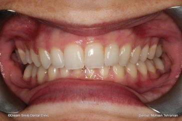 After Combination of Invisalign and 1 E-max Crown