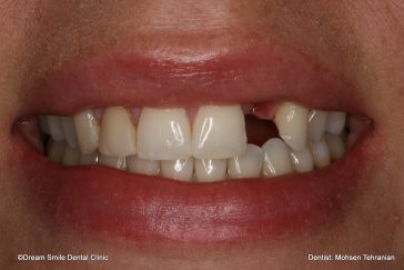 Before Implant and crown on lateral Incisors