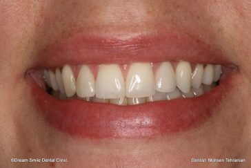 After Implant and crown on lateral Incisors