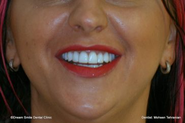 After Emax veneers no preperation