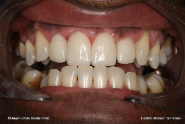 After 2 crowns and 2 veneers