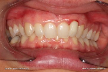 Before Combination of Invisalign and 1 E-max Crown