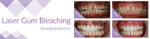 Laser Gum Bleaching