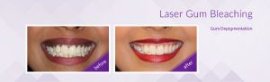 Laser gum bleaching treatment