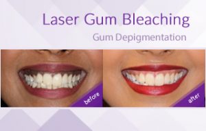 Gum bleaching treatment